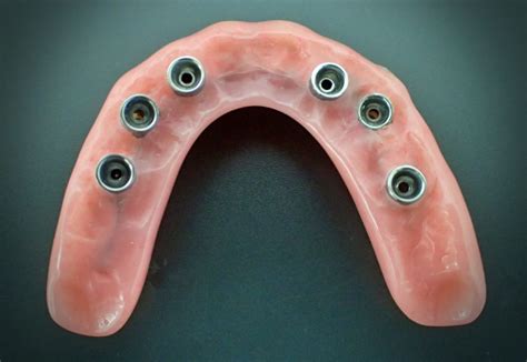 Fixed Implant Retained Hybrid Dentures - ProCare Denture Clinic ...