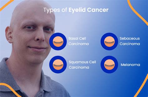 ACTC Health Guide: Understanding Eyelid Cancer Types, Symptoms, and Treatment | by ACTC Health ...