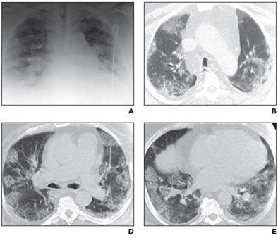 Bilateral Lung Crackles - bestdasta