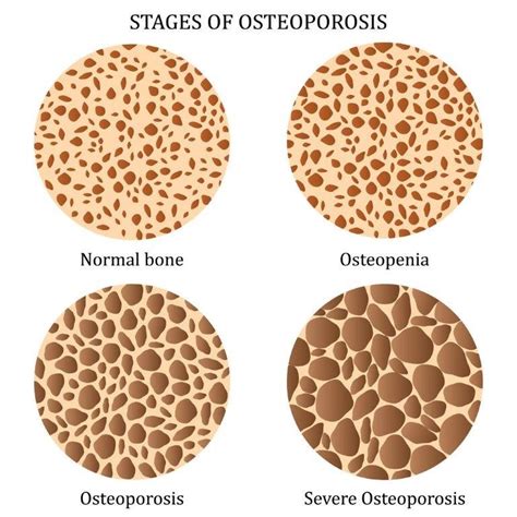 Osteoporosis Treatment & Low Bone Density | Bone Specialist