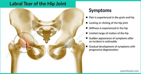 Labral Tear of The Hip Joint-Know Its Causes, Symptoms, and Treatment | Labral tear | Torn ...