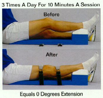 Knee Flexion Contracture : Wheeless' Textbook of Orthopaedics