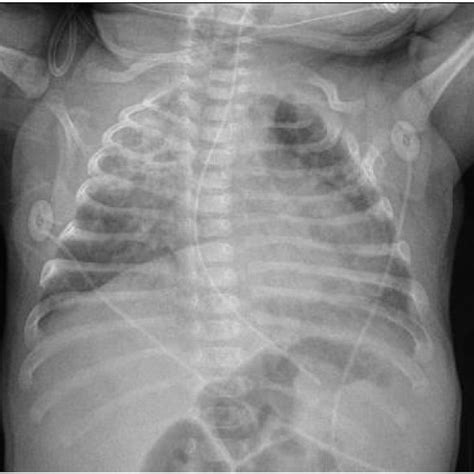 (PDF) Successful treatment of post-infectious pneumatocele via percutaneous drainage in a ...