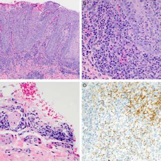 A, A biopsy from a buccal mucosa ulcer revealed a plasma cell-rich ...