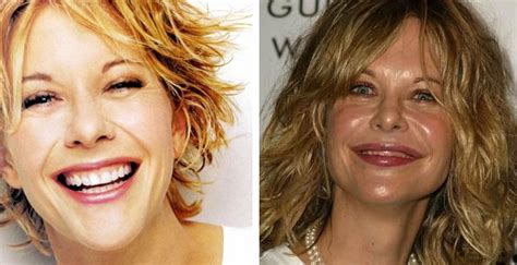 Chatter Busy: Meg Ryan Plastic Surgery