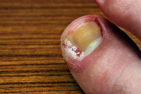 Ingrown Toenails - The Foot Care Group