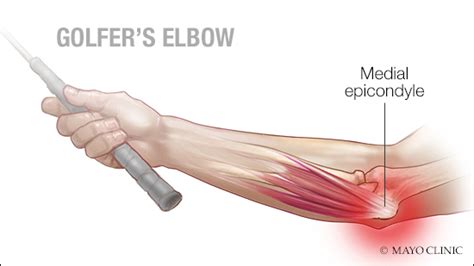 Mayo Clinic Q and A: Understanding 'golfer's elbow' - Mayo Clinic News ...