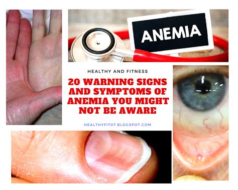 20 Warning Signs And Symptoms Of Anemia You Might Not Be Aware