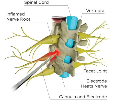 Radiofrequency Ablation | BioSpine Institute