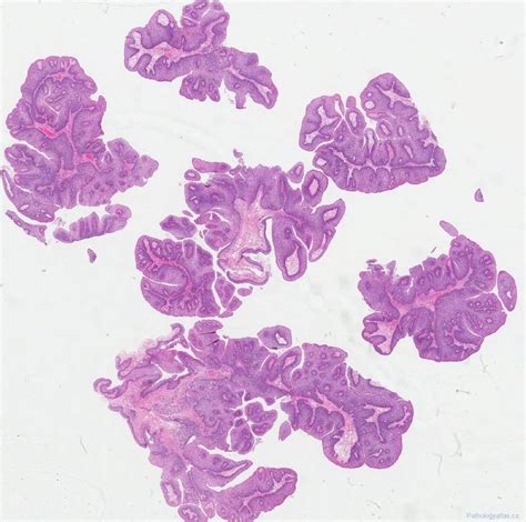 Laryngeal papillomatosis | Ottawa Atlas of Pathology