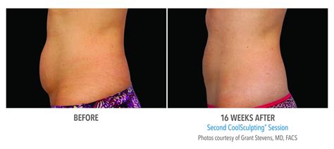 CoolSculpting Abdomen / Stomach Before and After Photos NYC