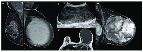 Imaging findings of a malignant phyllodes tumor. (A): Bilateral... | Download Scientific Diagram