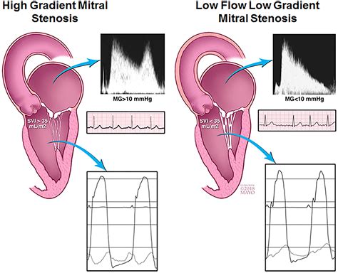 Low‐Gradient Severe Mitral Stenosis: Hemodynamic Profiles, Clinical Characteristics, and ...