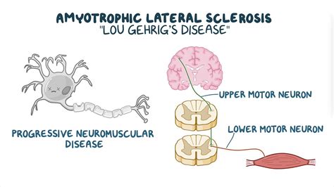 Amyotrophic lateral sclerosis (ALS): Nursing - Osmosis Video Library