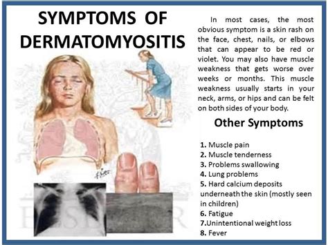 Dermatomyositis Leg Rash