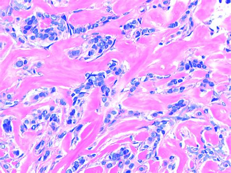 Pathology Outlines - Trichilemmoma