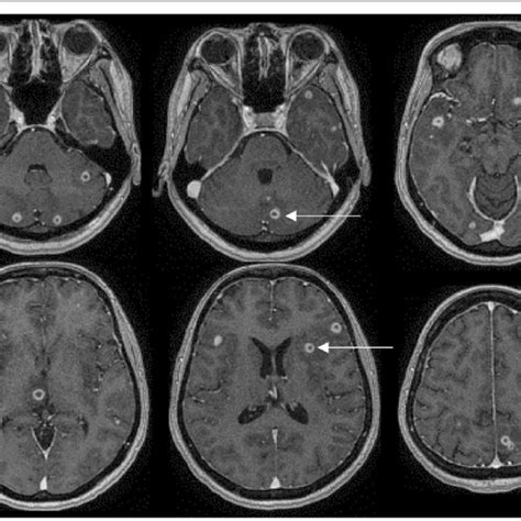 Maternal MRI showing small ring-enhancing lesions in both cerebral and... | Download Scientific ...