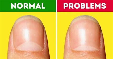 Lunula Function (Nail Problems): With Pictures, Videos, And FAQs