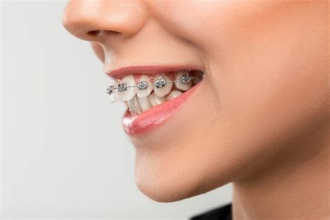 Invisalign: Teeth Alignment For Perfect Smiles - Happy Smile Forall