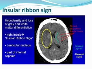 Imaging in ischemic stroke | PPT