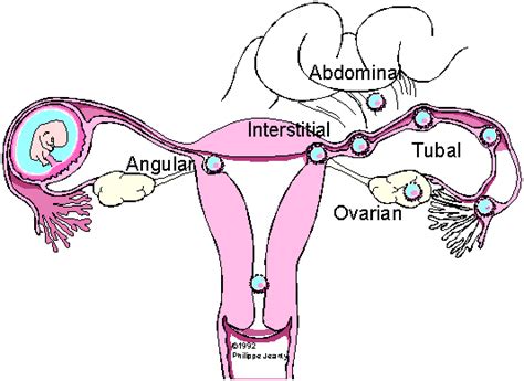 📃 Interstitial pregnancy: color Doppler demonstration