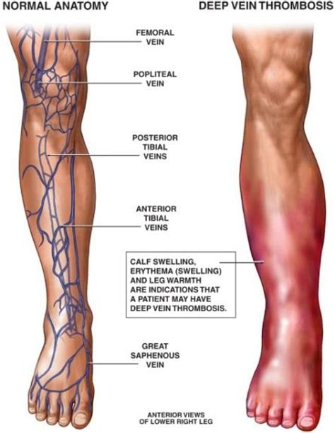 Deep Vein Thrombosis | Vein thrombosis, Deep vein thrombosis, Thrombosis