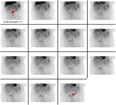 Meckel’s Diverticulum Imaging