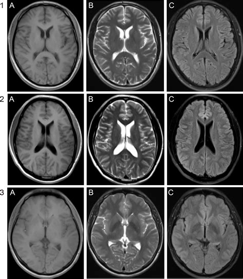 Neurosyphilis Mri