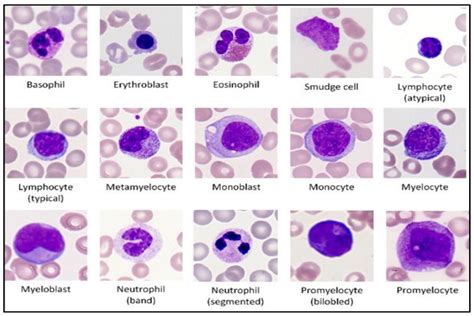 Acute Myeloid Leukemia Aml Morphology What To Know | Hot Sex Picture