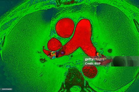 Pulmonary embolism in the left and right pulmonary arteries, seen on... Nachrichtenfoto - Getty ...