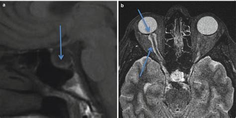 The Sella Turcica | Obgyn Key