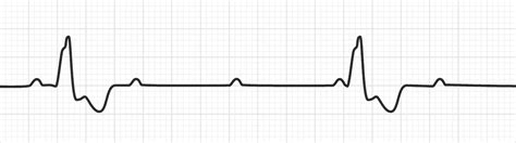 Ventricular Escape Rhythm | Bradyarrhythmias - MedSchool