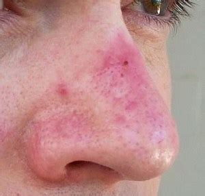 How to cure a Red Swollen Nose : Rosacea Support Group