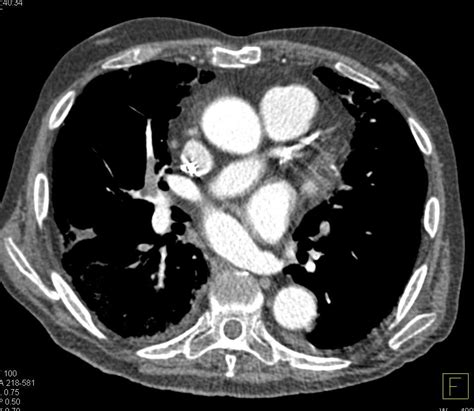 Multiple Bilateral Pulmonary Emboli - Chest Case Studies - CTisus CT Scanning