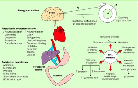 Hepatic encephalopathy and ascites - The Lancet