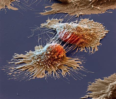 Cancer cells under an electron microscope : pics