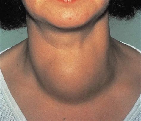 Thyroid Goiter - Causes, Symptoms, Treatment, Diagnosis and Prevention :: Galleria Community ...