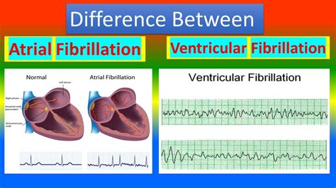 What Is The Difference Between Atrial Fibrillation A - vrogue.co