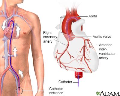 Coronary angiography Information | Mount Sinai - New York