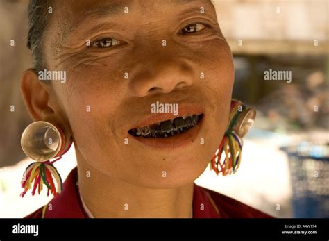 Teeth of a Betel Nut Chewer Stock Photo: 2068851 - Alamy