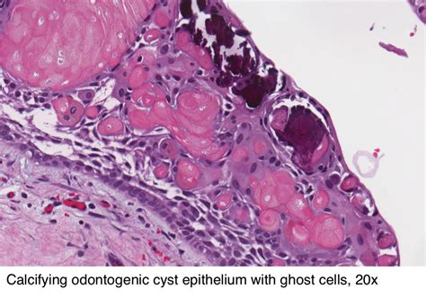 Pathology Outlines - Calcifying odontogenic cyst