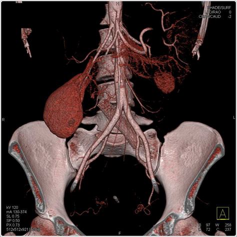 Stent in Left Iliac Vein in Patient with May–Thurner Syndrome ...