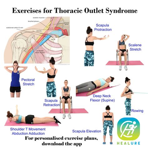 Thoracic Outlet Syndrome Exercises