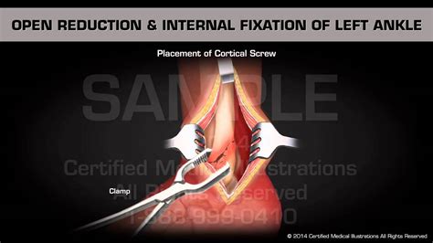 Open Reduction & Internal Fixation of Left Ankle - YouTube