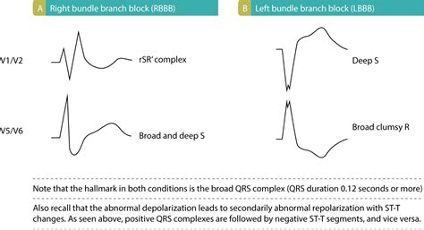 Intraventricular conduction delay: bundle branch blocks & fascicular blocks – Cardiovascular ...