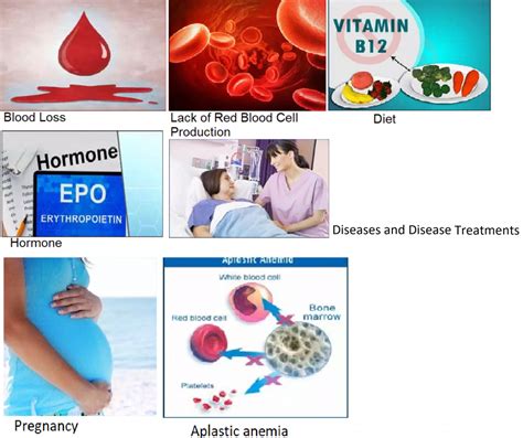 Causes of Anemia - drugpharmamagazine.com