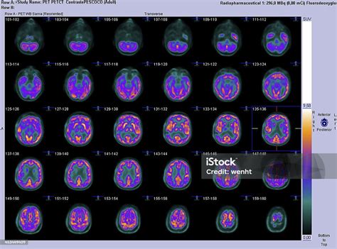 Petct Axial Scan Of The Brain Stock Photo - Download Image Now - PET Scan, Brain, Medical Scan ...