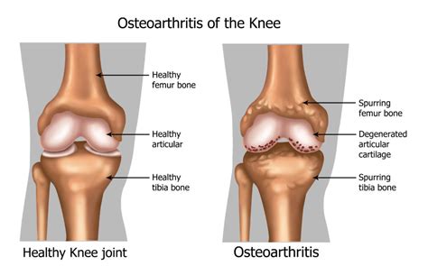 Physical Solutions | Gel Injections for Osteoarthritis in the Knee - Physical Solutions