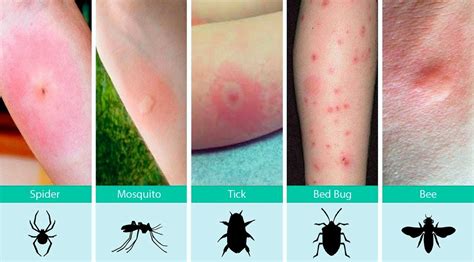 The Health Website : Insect Bites and Stings