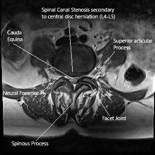 Diagnosis of Sciatica - Complete Orthopedics & Podiatry | Multiple NY ...